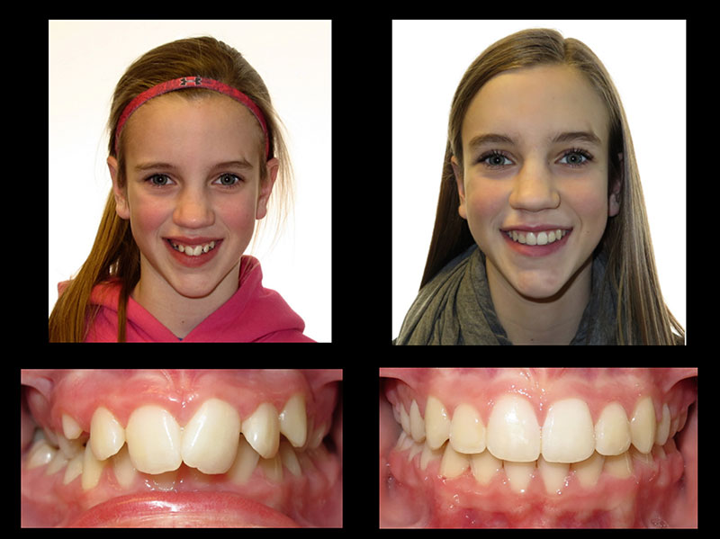 How Orthodontic Braces Work - Kyger Orthodontics BlogKyger Orthodontics Blog