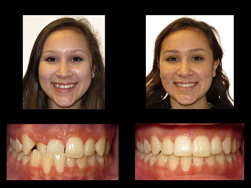 overbite before and after